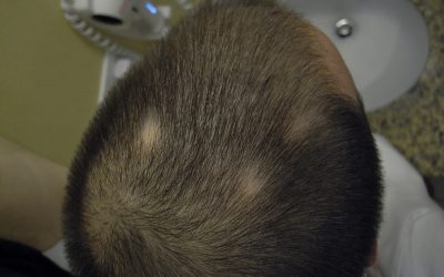 Calcipotriol recurso apto en alopecia areata