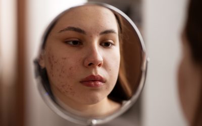 Seguridad de nueva triple asociación en el tratamiento del acné