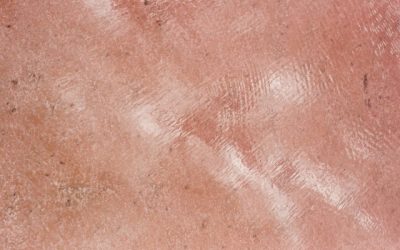 Asociación de interés en tratamiento y mantenimiento de dermatitis seborreica facial